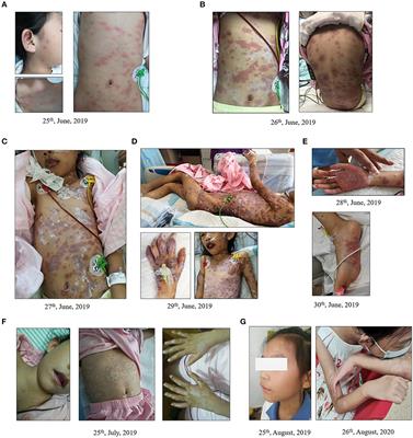 Erythema Multiforme Major Associated With Community-Acquired Pneumonia: Lessons From a Case Report